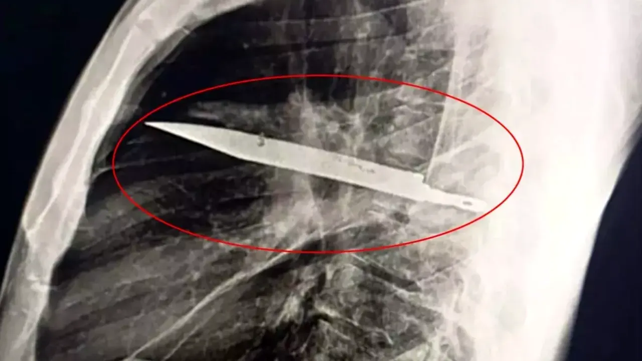 Consecințele unei bătăi de stradă. Un tanzanian a trăit opt ani cu o lamă de CUȚIT în piept