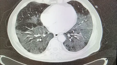 DEZVĂLUIRE ORIBILĂ. Adevărul despre cum îi afectează CORONAVIRUSUL pe TINERI. Un medic explică totul!