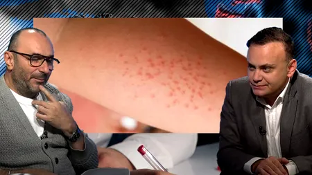 VIDEO | Adrian Marinescu: „La Institutul Matei Balș avem foarte multe cazuri de rujeolă. Poate fi prevenită ușor, prin vaccinare”