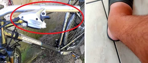 Din greșeală, un medic de la Spitalul Urlați a uitat un MÂNER de bicicletă, în piciorul unui pacient pe care l-a cusut. Ce a urmat