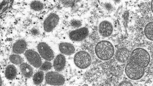 OMS susține că nu există dovezi privind mutaţii ale virusului variolei maimuţei: „Este o situaţie care poate fi ţinută sub control. Transmiterea variolei maimuței poate fi oprită în țările non-endemice”