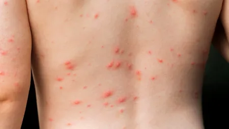 Varicela hemoragică - o boală extrem gravă, îmbolnăvește copiii din România. Un băiețel de 7 ani este internat la Spitalul de Boli Infecţioase din Timişoara. Ce spun medicii