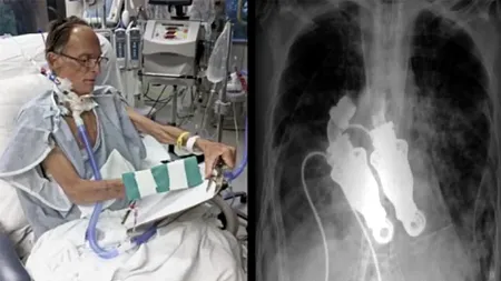Viața bate filmul! Povestea primului om din istoria lumii care a trăit fără inimă
