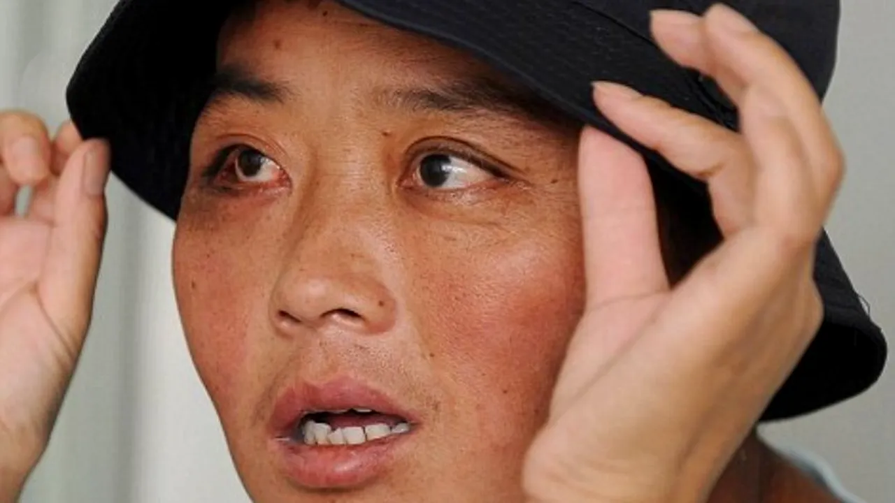 Cum arată o femeie din China înainte ca medicii să-i îndepărteze 70 de tumori de pe față

