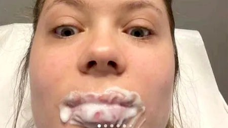 Ce a pățit TÂNĂRA din imagine, la exact 3 ore după ce a folosit lip filler cu acid hialuronic