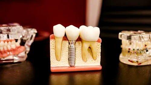 5 motive să-ți faci un implant dentar