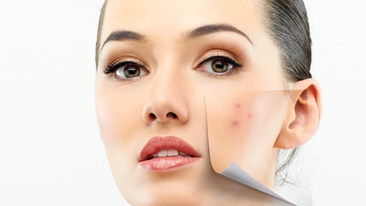 10 adevăruri și mituri despre acneea la adulți