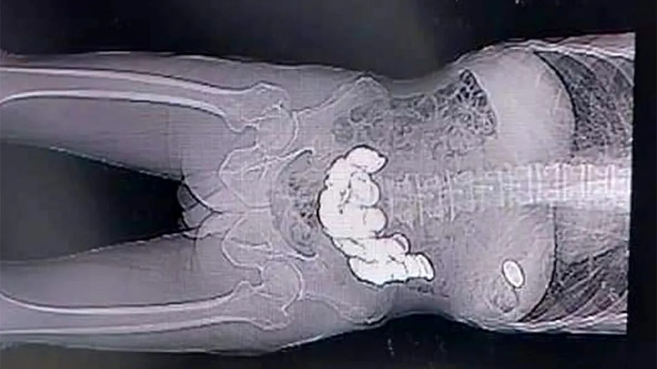 Caz unic în istoria omenirii! Ce au găsit medicii în stomacul unui bărbat care se internase pentru că se simțea 