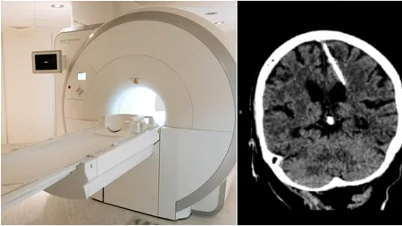 Halucinant! A trăit 80 de ani cu un ac înfipt în creier. Chiar părinții i-au făcut asta, încercând să o omoare la naștere
