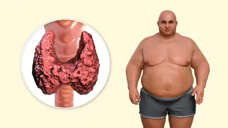 5 remedii naturale pentru hipotiroidism. Cum tratezi tiroida LENEȘĂ, care nu te lasă să slăbești