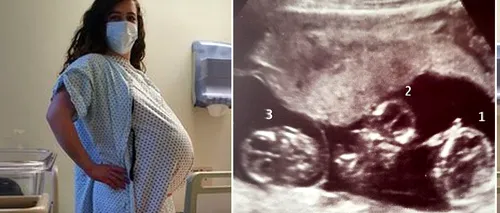 Caz aproape unic în istoria omenirii! Ce a născut graviduța din imagine. Se întâmplă o dată la 200.000.000 de cazuri