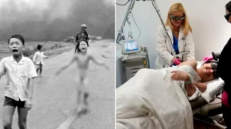 ”Fetița Napalm” din Vietnam a făcut ultimul tratament de piele la 59 de ani. Care este povestea ei