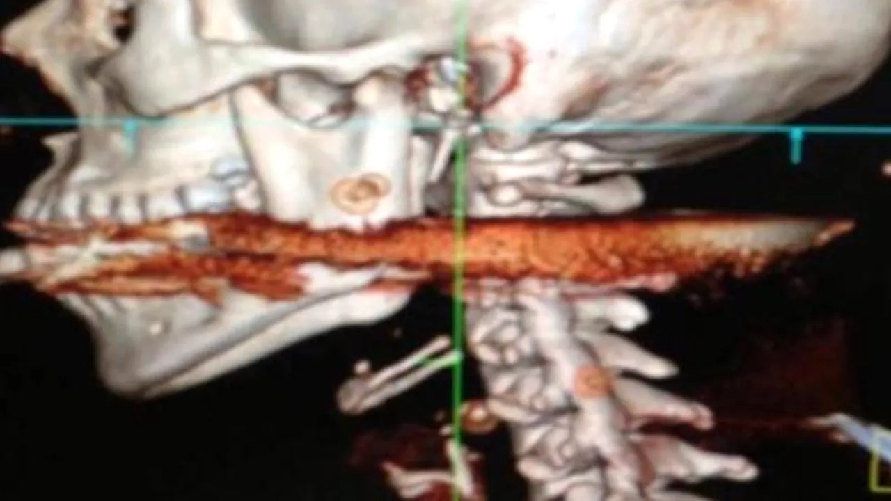Caz inedit. O femeie a supraviețuit după ce soțul ei i-a străpuns fața cu un harpon