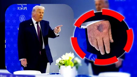Trump a dat cu pumnul în masă la propriu. Casa Albă precizează că președintele și-a învinețit mâna când s-a lovit de masă la Consiliul pentru Pace