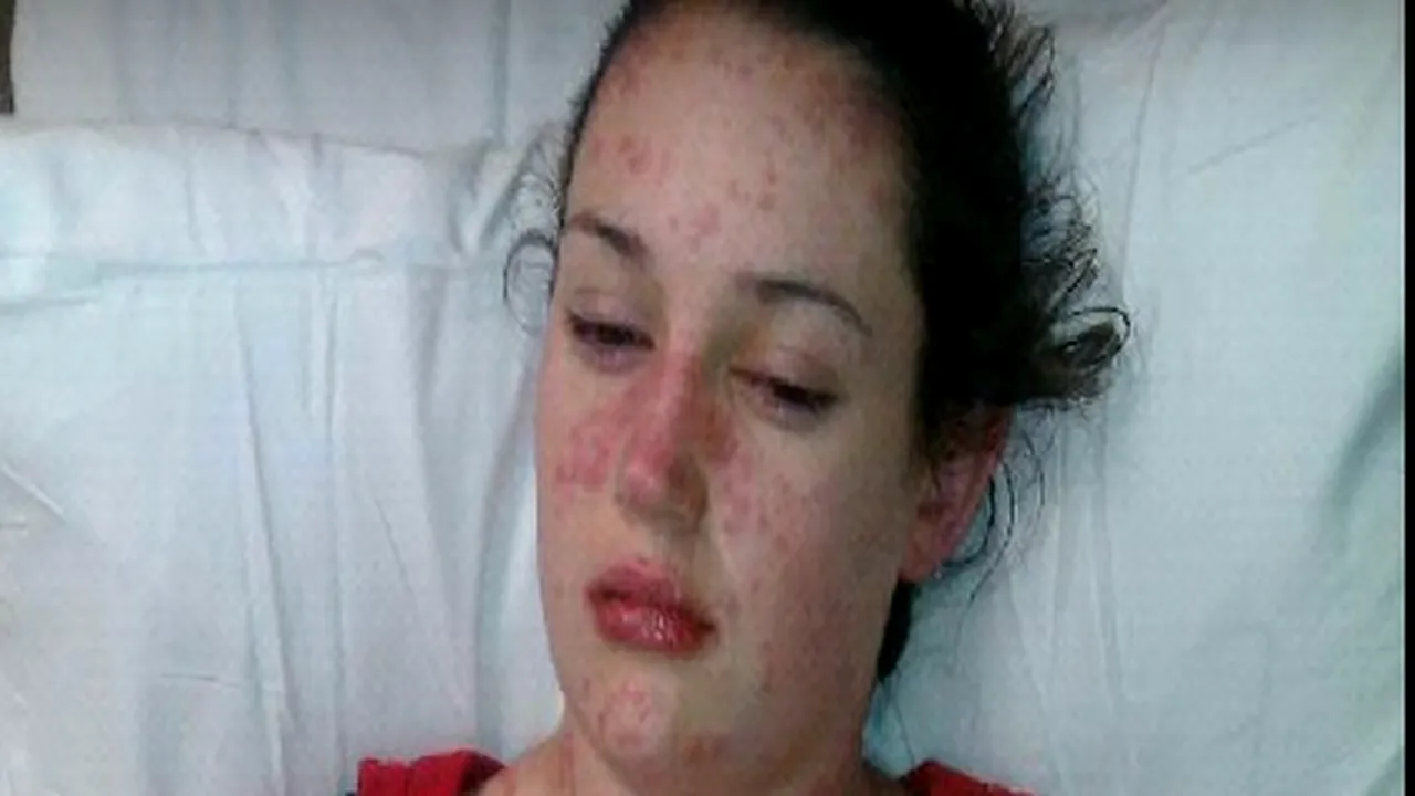 Caz medical șocant: Și-a luat medicamentele de epilepsie, dar reacția organismului a fost total neașteptată. „Ardea dinăuntru spre exterior