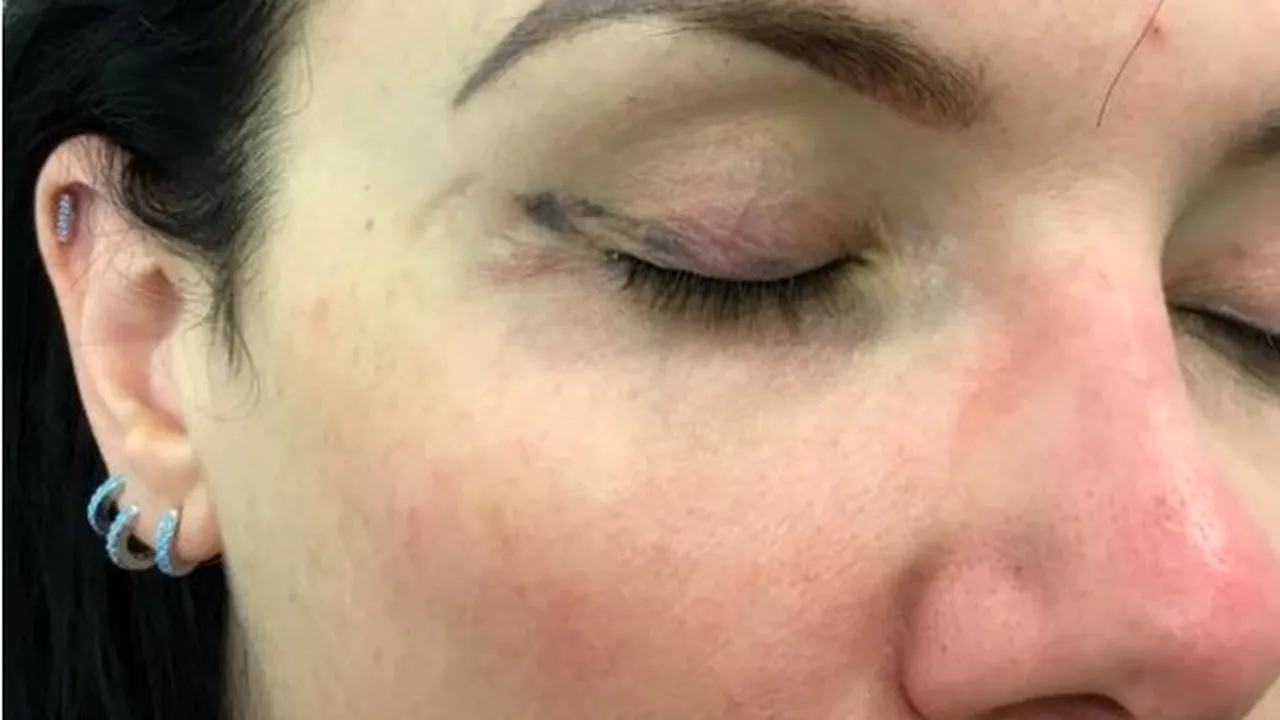 „Mi-a distrus fața. A fost îngrozitor de dureros!