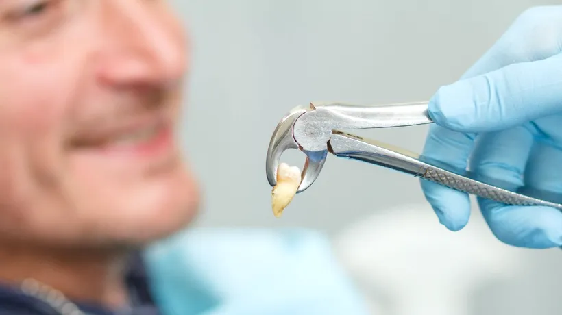 Extracția dinților: cum să te pregătești pentru procedură