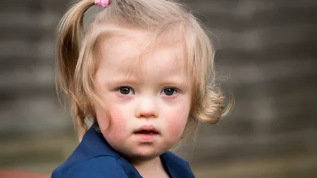 Prima țară din lume în care aproape nimeni nu mai dă naștere copiilor cu sindrom Down. Motivul este unul controversat