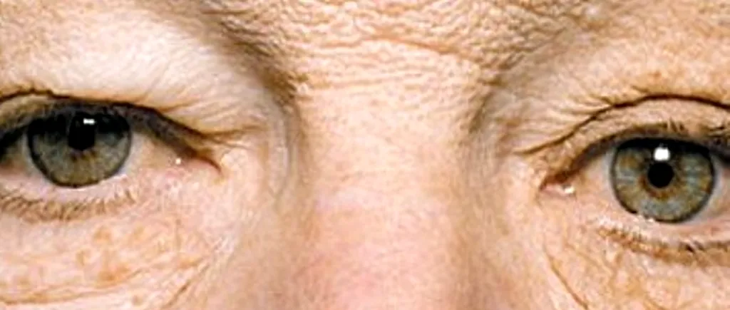 ORBITOR. Partea stângă a feței unui bărbat a îmbătrânit de la expunerea prelungită la soare