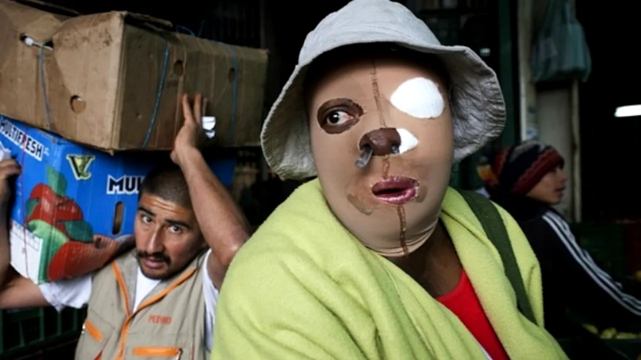 DRAMA femeilor desfigurate cu acid: 