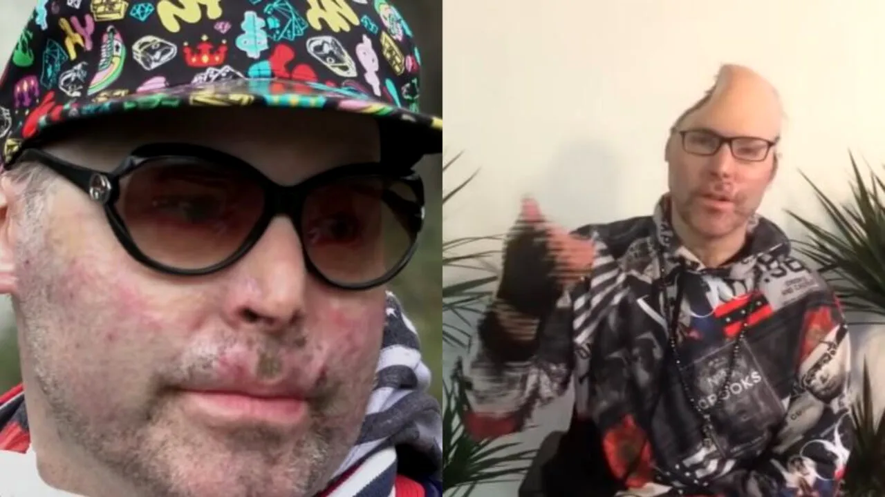 VIDEO | Rapper mutilat în timp ce prepara ulei de canabis. Niko a rămas fără jumătate din craniu, în urma unei explozii: „Am făcut o greșeală uriașă”