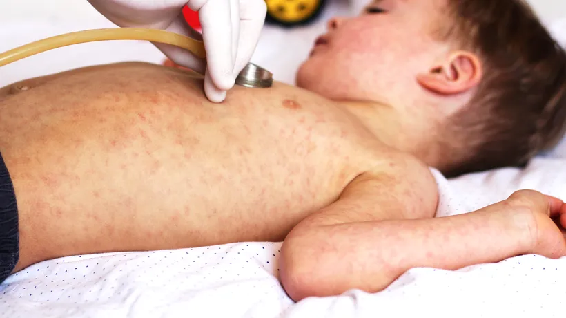 OMS recomandă vaccinarea de urgență a copiilor împotriva rujeolei în Europa. Numărul de cazuri, de zeci de ori mai mare în 2023 față de anul anterior
