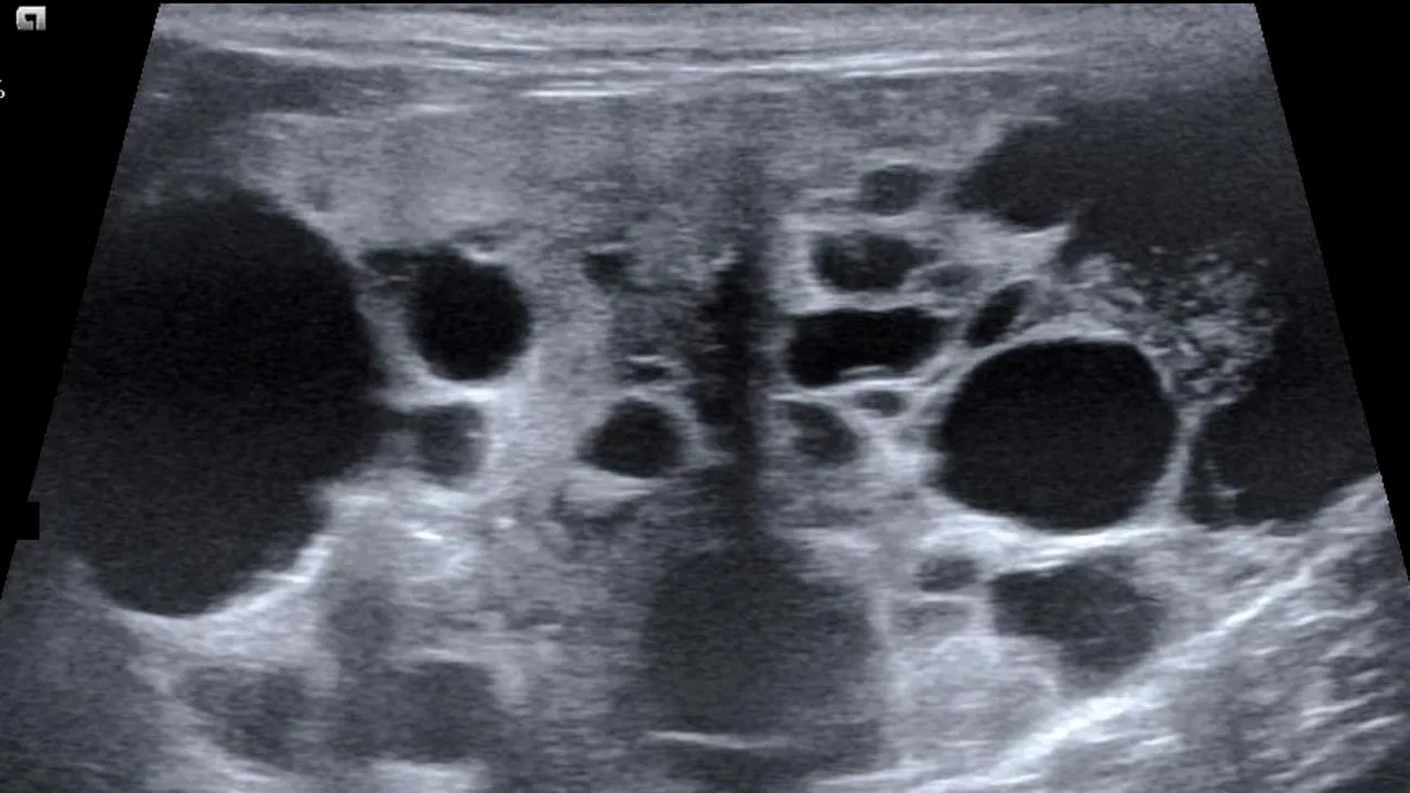 Un bărbat și-a purtat în burtă fratele geamăn timp de 36 de ani. FOTO cu „gravidul” care a uimit lumea științei