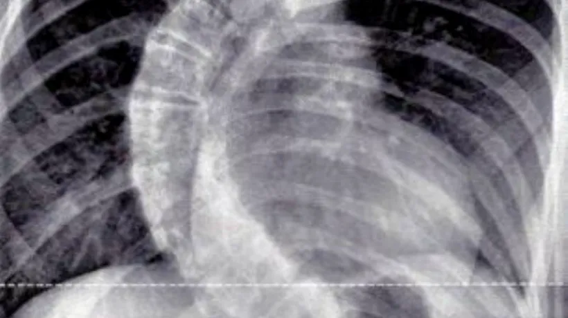 Medicii britanici au fost uimiți când au văzut radiografia unei fete de 13 ani: „Este cel mai grav caz pe care l-am întâlnit