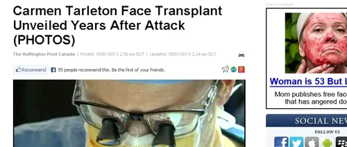 Cum arată femeia desfigurată cu leșie, la trei luni după transplantul de față