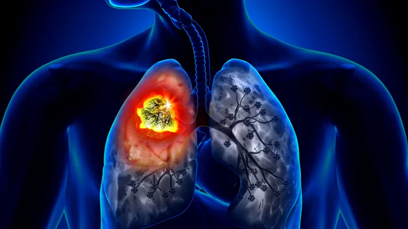 Românii care vor să afle dacă au simptomele cancerului pulmonar pot face un test online