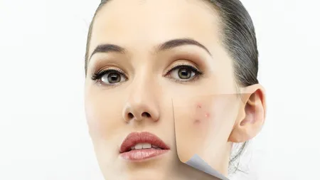 Motivele pentru care acneea se accentuează primăvara