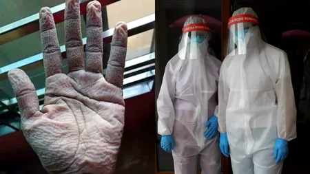 Imagini impresionante ale efectelor pe care le au echipamentele de protecție asupra medicilor din prima linie „A sta îmbrăcat în acel costum te costă”