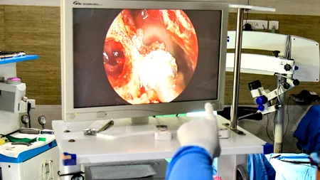 România a înregistrat primul caz de „ciupercă neagră” de anul acesta. Medicii avertizează că afecțiunea poate fi mortală dacă nu este tratată la timp