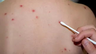 Focar de rujeolă într-o mare capitală din Europa. Peste 60 de copii infectați, medicii sunt în alertă