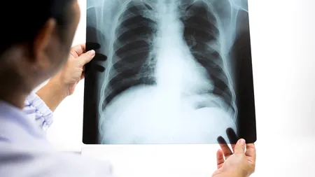Efectele coronavirusului: Plămânii pacienților, „inundați” de un lichid ca „jeleul”. Avertismentul doctorilor