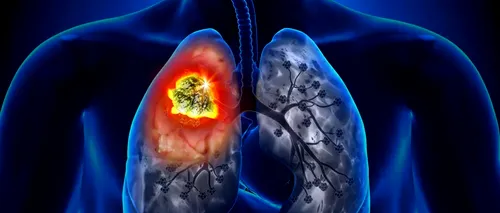 Din ce orașe poluate provin mulți români care mor de cancer pulmonar. Aproape 11 mii de pacienți sunt uciși anual de această boală