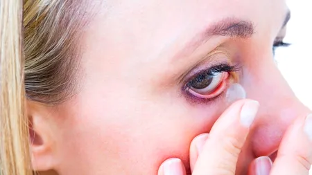 VIDEO O femeie a ajuns la urgențe după ce după ce a adormit cu lentilele de contact pe ochi. Medicii au fost șocați de ceea ce au descoperit în ochii femeii