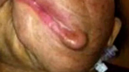 O femeie desfigurată de o tumoare gigant, supusă unui transplant facial total