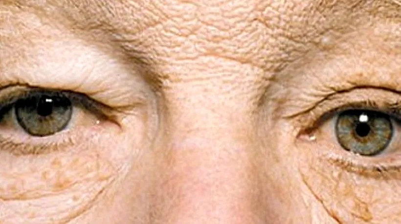 ORBITOR. Partea stângă a feței unui bărbat a îmbătrânit de la expunerea prelungită la soare
