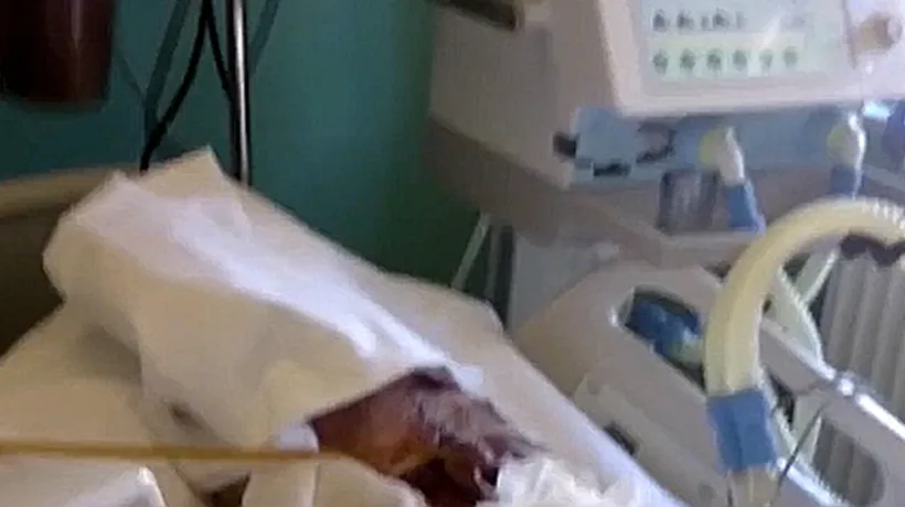 Reacția ministrului Sănătății, după imaginile șocante la Spitalul de Arși. Viermii colcăie pe un pacient. VIDEO