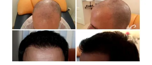 (P) Cum scapi de alopecie? Află aici informații despre implantul de păr și tehnica Q-FUE