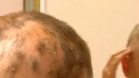 Bianca Drăgușanu riscă să CHELEASCĂ