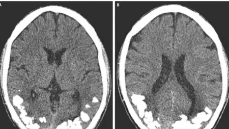 Caz medical neobișnuit în Brazilia. A ajuns la spital cu migrene, iar medicii i-au spus că are 