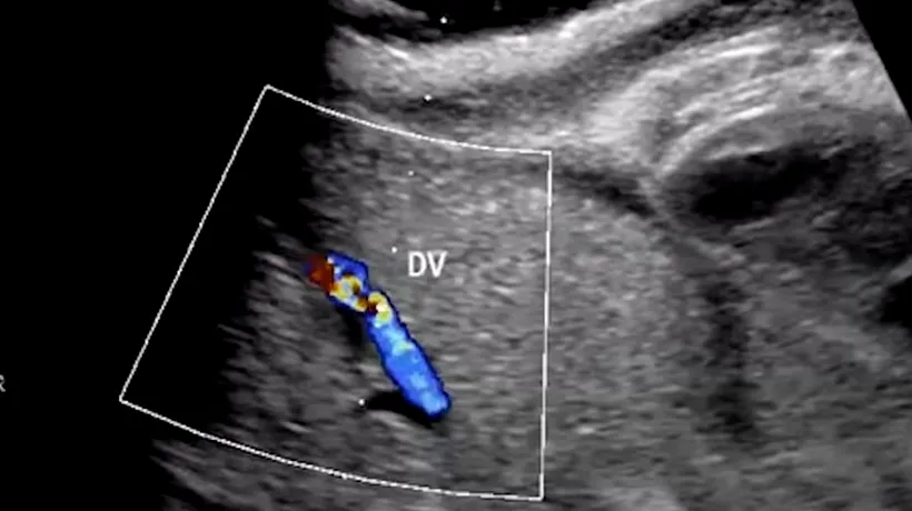 A fost inventat „uterul artificial. Metoda dezvoltată de cercetători, care ar putea însemna o șansă la viață pentru prematuri. VIDEO