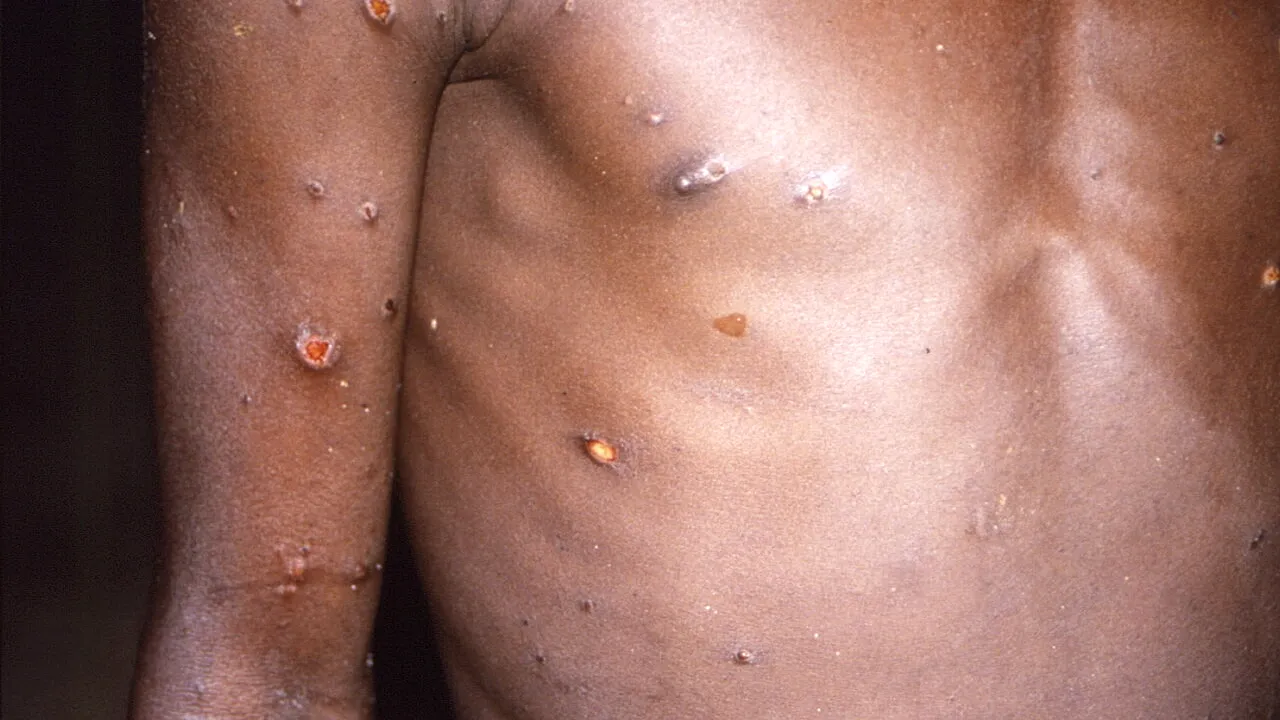 OMS a realizat profilul pacientului vulnerabil în fața variolei maimuței. Ce persoane sunt expuse bolii