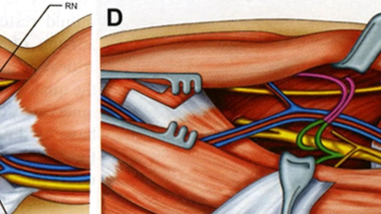 Premieră mondială în medicină: prima operație de transfer de nerv a fost un succes