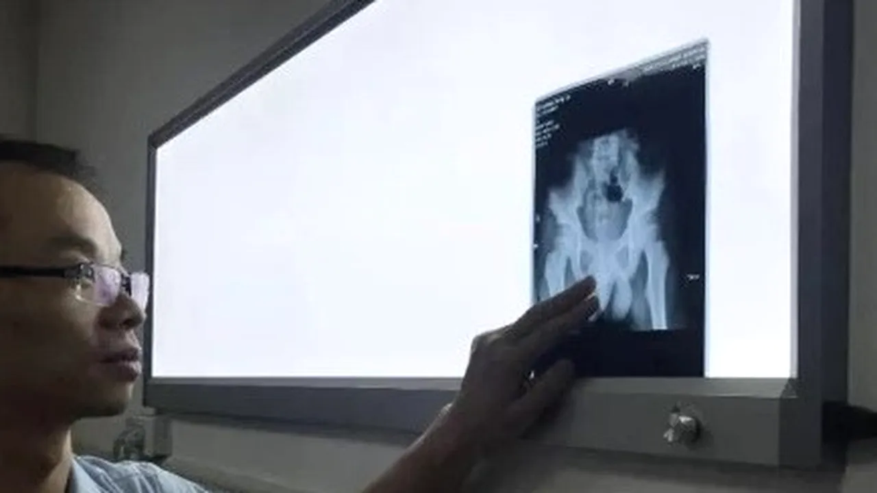 Măsură extremă: Un băiat și-a introdus un ac în penis. Motivul: Trebuia să stau treaz să-mi fac temele - GALERIE FOTO