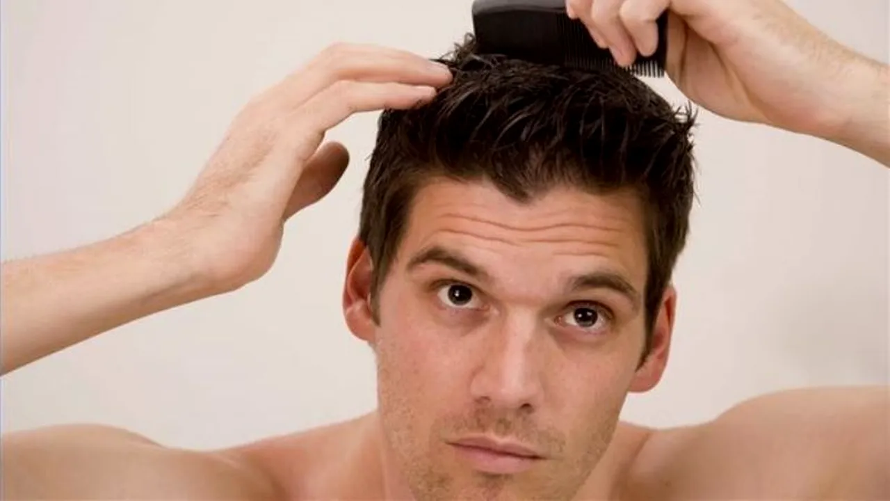 Vești bune pentru milioane de bărbați care suferă de calviție