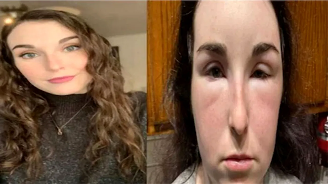 O femeie a ajuns în spital, după ce vopseaua de păr i-a provocat reacții alergice severe. Acum este de nerecunoscut