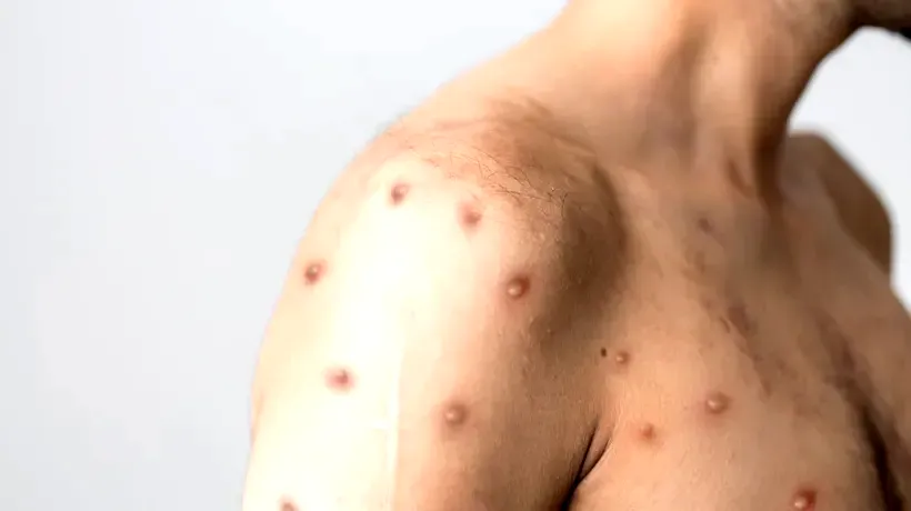 Un nou caz de variola maimuței, diagnosticat în București. Bilanțul total al pacienților infectați cu această boală urcă la 16, în România